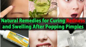 Natürliche Heilmittel für die Heilung von Rötung und Schwellung nach Pickel Popping 