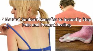 5 Natural Sunburn Remedies, um sofort zu stoppen Schmerzen und Peeling zu verhindern 