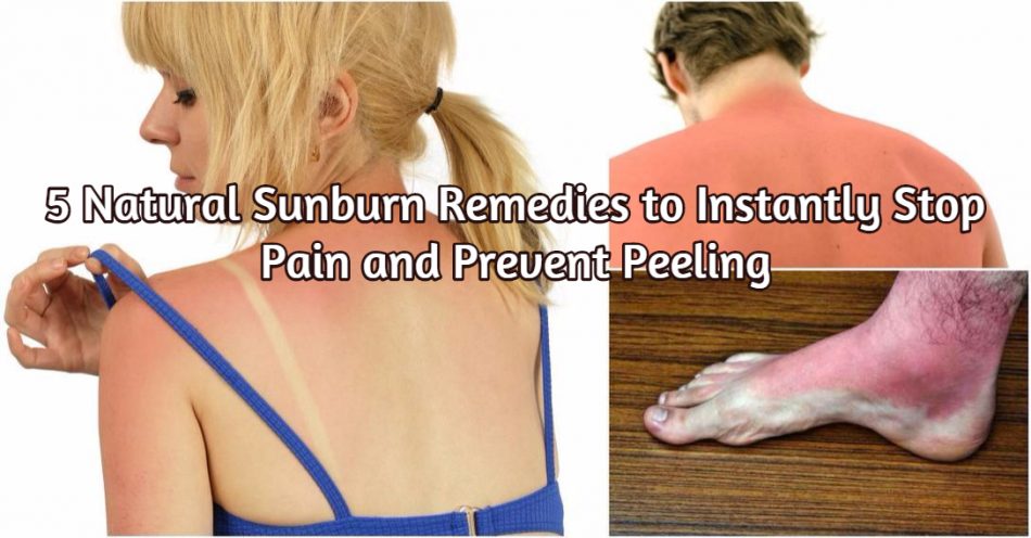5 Natural Sunburn Remedies, um sofort zu stoppen Schmerzen und Peeling zu verhindern 