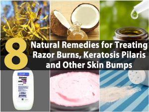 8 natürliche Heilmittel zur Behandlung von Rasur Verbrennungen, Keratosis Pilaris und andere Haut Beulen 
